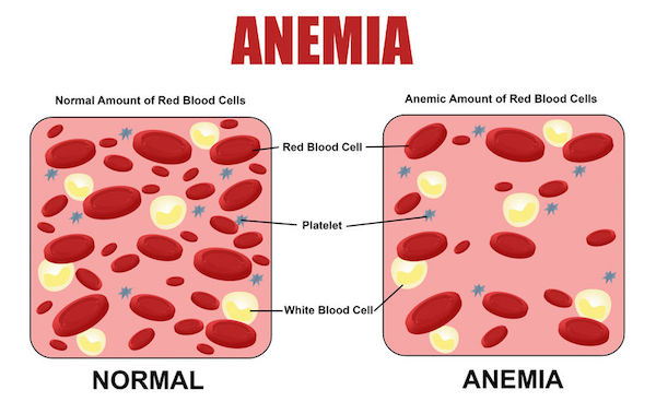 Anaemia reduction program launched in 50 girls’ schools