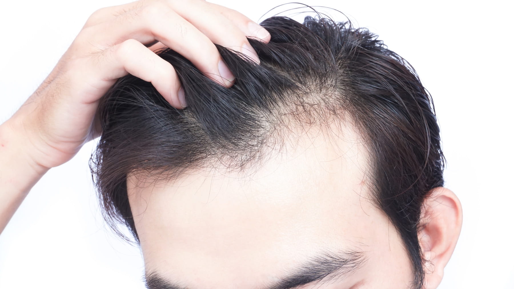 Dermatologist urges applying organic stuff on scalp to prevent hair loss